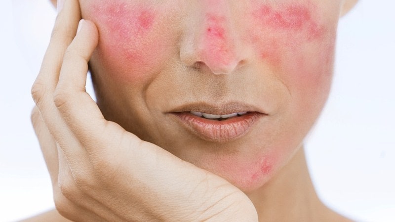 Reduce redness on face overnight