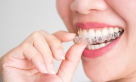 Best Braces to Straighten Teeth – Revealed!